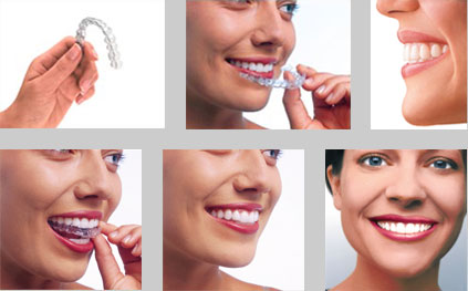 Invisalign-006