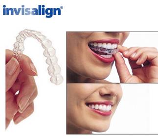 Invisalign-5