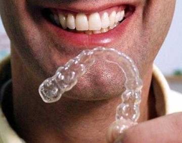Invisalign-image008