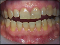 tetracyclineteeth