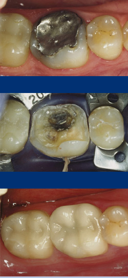 inlay-onlay-phuc-hoi