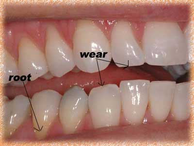 sensitive-teeth-photo