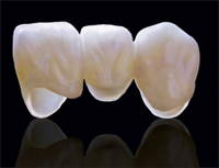 rang-su-khong-kim-loai