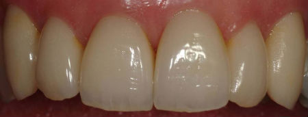 rang-su-tren-mieng-benh-nha