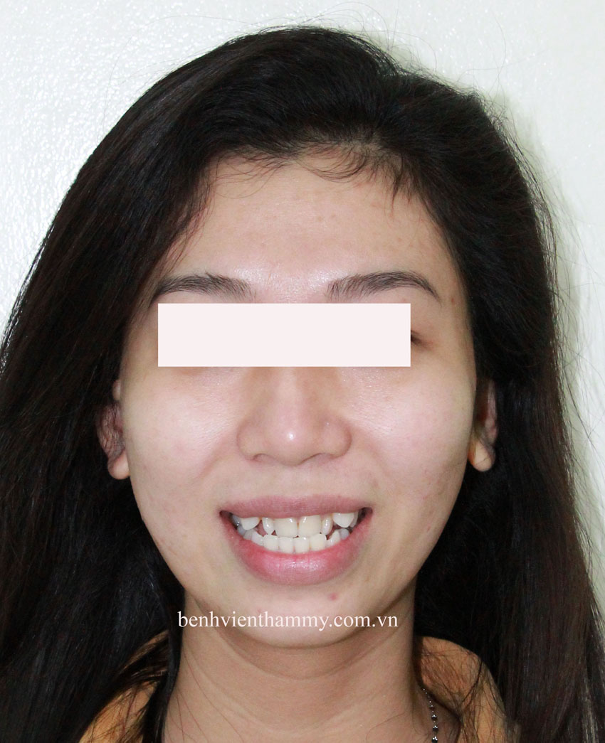 tri rang mom hieu qua 1