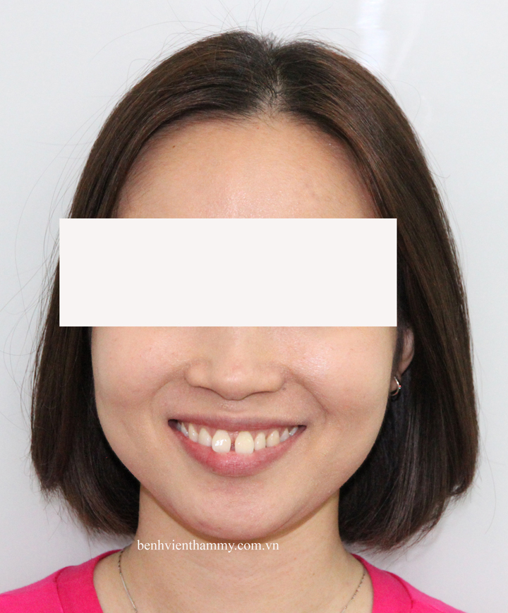 truoc copy1